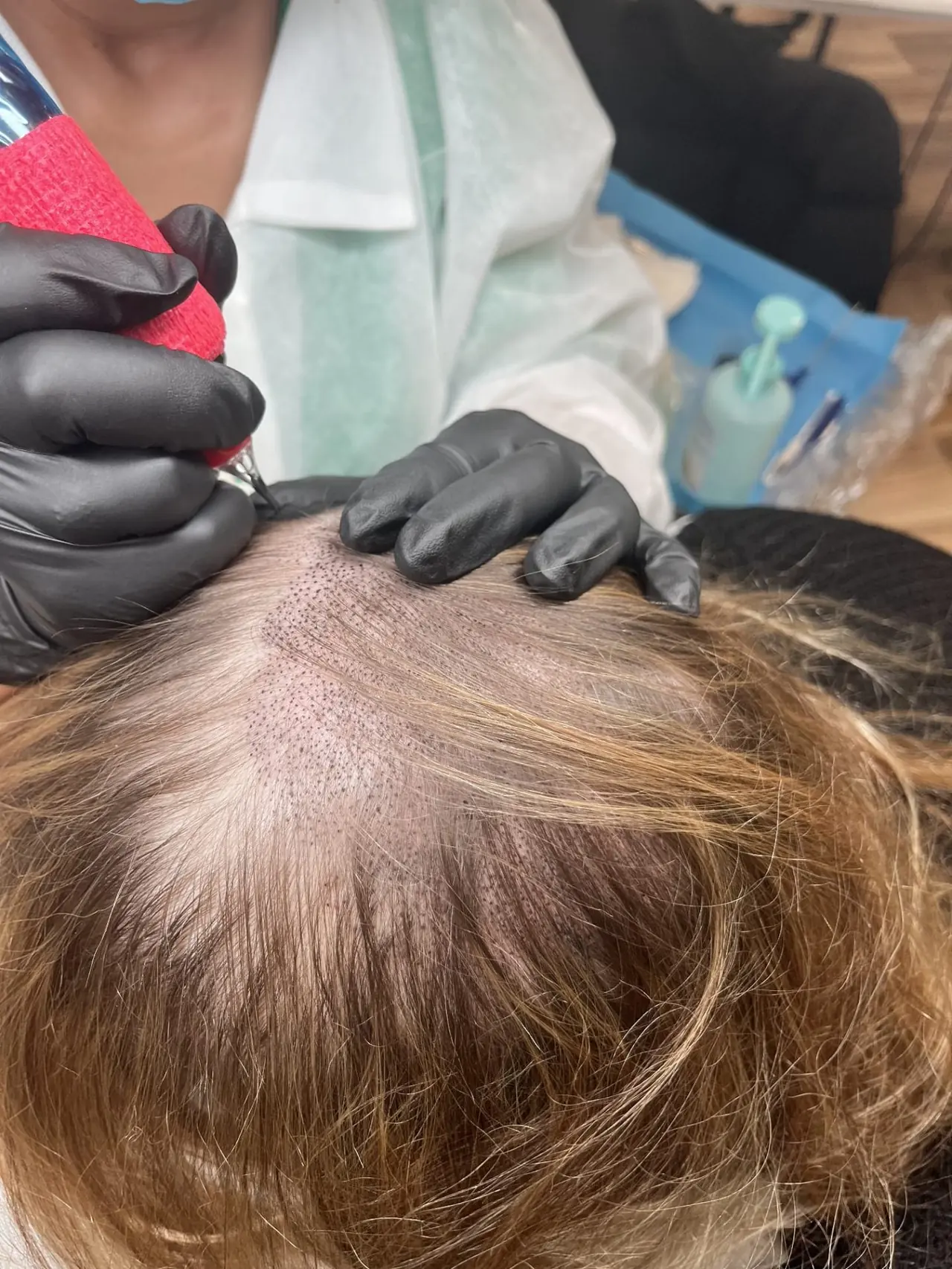 Alopécie féminine — raie — résultat réalisé au studio Dermagrafia