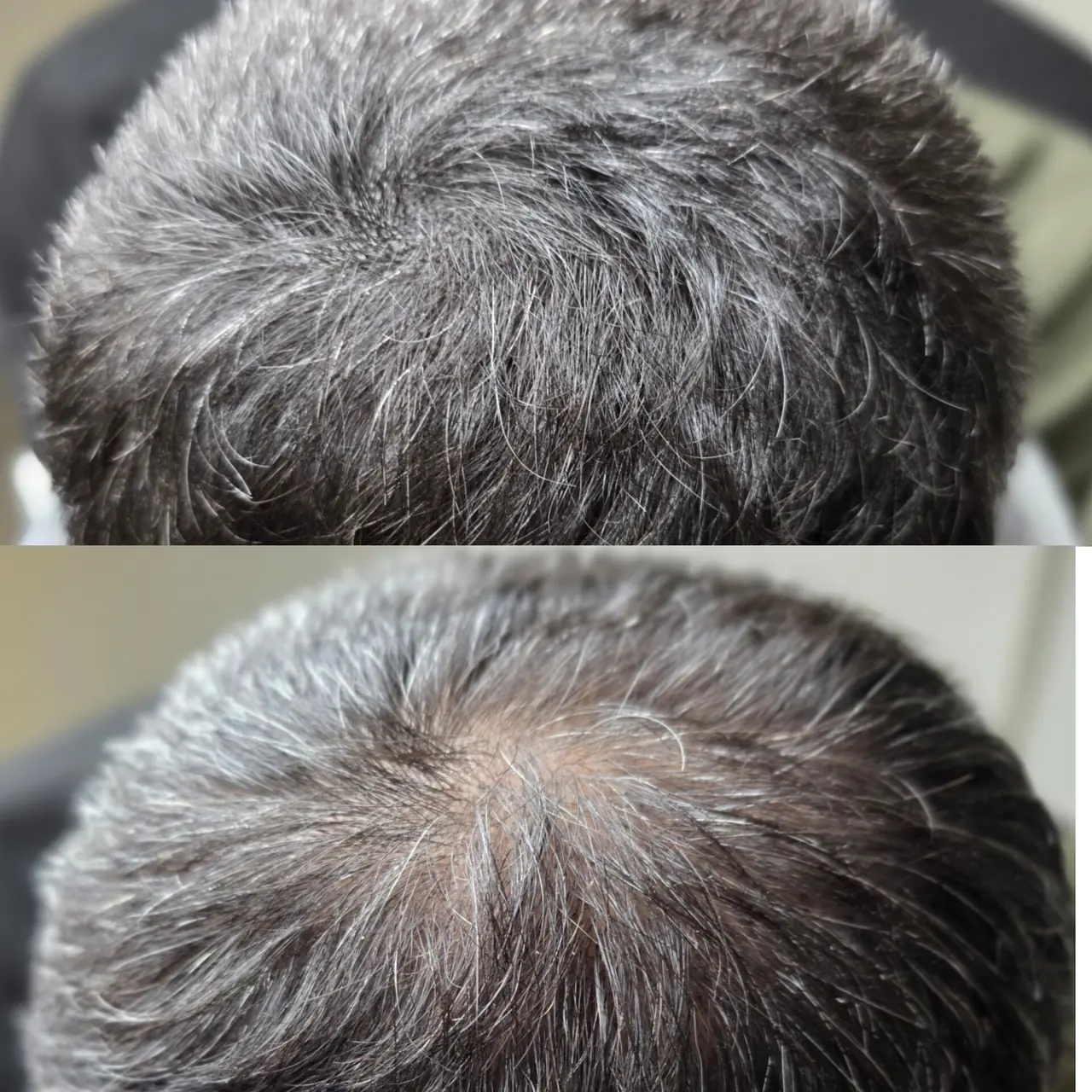 Effet densité — vertex — résultat réalisé au studio Dermagrafia